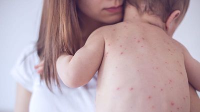 Measles cases rose 47% in Europe and Central Asia last year amid global surge in outbreaks, WHO says