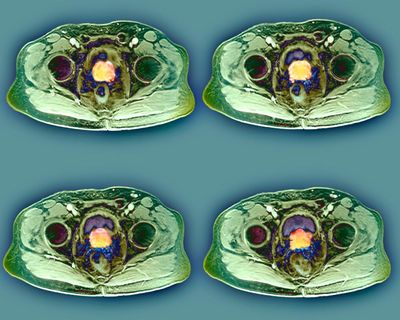What is prostate cancer and should I be worried if I wee a lot at night?