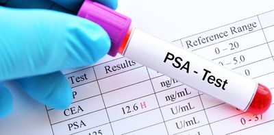 Prostate cancer screening rejected by UK government advisers – here’s why