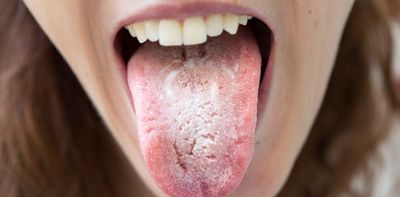 Antifungal resistance is making thrush hard to treat – here’s why