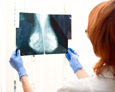 Discussing breast density after mammograms may cause unneeded anxiety, study finds