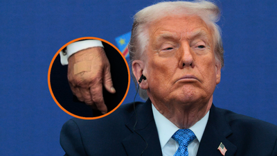 ‘Borderline Weekend at Bernie’s’: Trump’s ‘bandaged and discolored hand’ exposed again, what the heck is going on with him?
