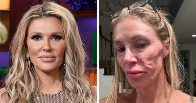 Brandi Glanville Finally Receives Diagnosis For Facial Disfigurement After Blaming A Parasite