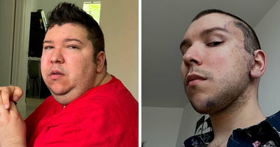 Nikocado Avocado Undergoes Cosmetic Surgery, Shares Results