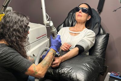 What it’s really like to have a tattoo burnt off you – and how much it will cost