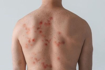 Warning issued after new mpox strain identified in England