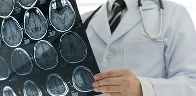 From stress to stroke: what can cause ‘holes’ and low-activity regions in the brain