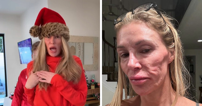 “Psychosis On Display”: Brandi Glanville Goes Bold In Red Bikini After Face Disfigurement Diagnosis