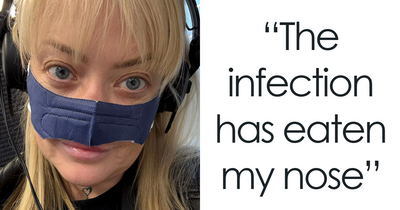 “My Face Is Changing Every Day!”: Woman’s $4k ‘Turkey Teeth’ Procedure Goes Horribly Wrong