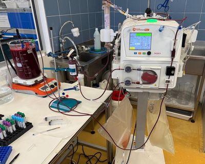 NHS to trial potentially life-saving treatment for deadly liver disease