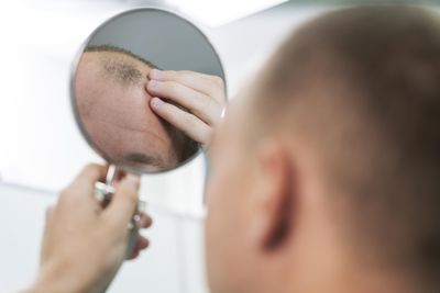 Hair Follicle Cloning Advances Accelerate in 2025, Signaling a Potential Endgame for Baldness