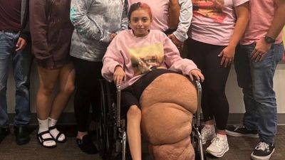 ‘She has challenges and she has pushed through’: Florida teen recovering after 17 hour surgery to remove 174lb leg