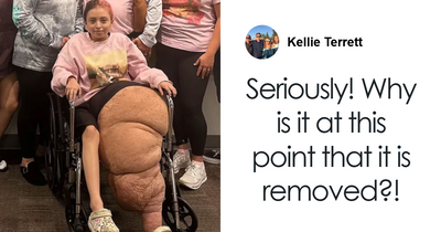 14YO Girl With Rare Condition Undergoes 17 Hours Of Grueling Surgery To Remove 174lb Leg