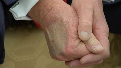 Is Trump's Health Declining? Questions Intensify As Bruising Appears On Both Hands In New Footage