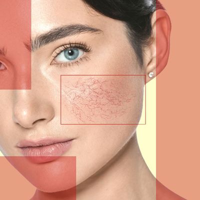 Pulsed Dye Lasers Are Your Dermatologist's Secret Weapon to Fight Pigmentation