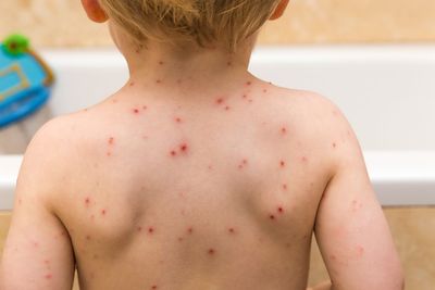 Chicken pox vaccine: How and where to get children free jab as NHS rollout begins