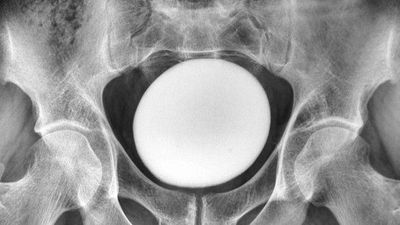 Diagnostic dilemma: Giant 'stone' in a man's bladder looked like an ostrich egg