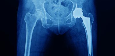 People as young as 50 can need a hip replacement – here’s everything you need to know about this common surgery