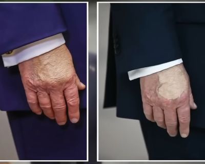 President Donald Trump Applies Makeup To Conceal Bruise As Health Queries Grow