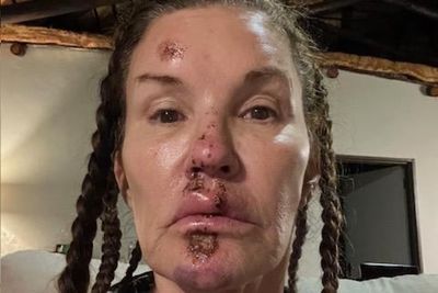 Supermodel sues I’m A Celebrity producers over alleged facial injuries