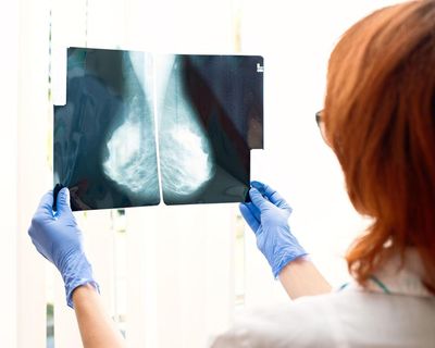 Simple blood test can predict which breast cancer treatment will work best, study finds