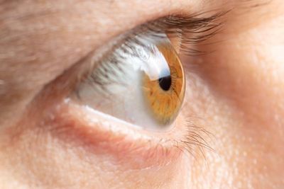 The common eye condition set to surge in the UK