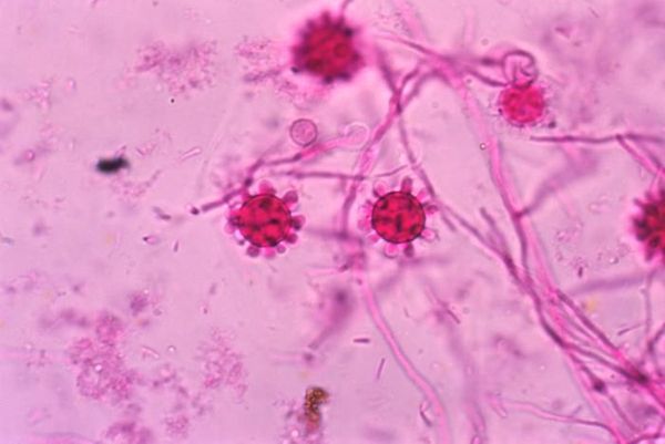 Outbreak of a rare fungal disease in Tennessee leaves one dead and dozens sick