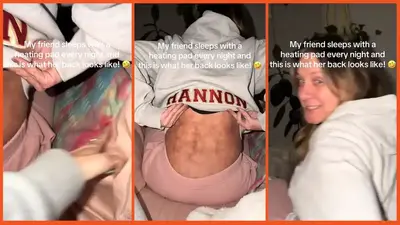‘Shes literaly cooking herself’: Woman didn’t think twice about sleeping on a heating pad. Then she showed her back