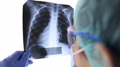 New NHS AI Scan and Robotic Biopsy Tech Could Catch Tiny Lung Cancers Earlier