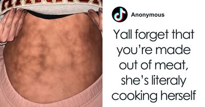 “She’s Literally Cooking Herself”: Woman With ‘Toasted Skin Syndrome’ Goes Viral