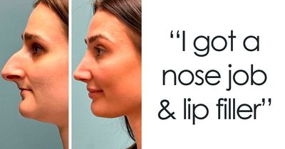 41 Striking Before-And-After Photos Of Plastic Surgery That Seriously Changed People’s Looks