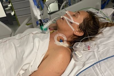 Mum lost leg to flesh-eating disease after thinking she had a cold