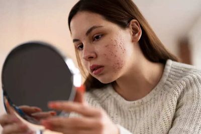 Common DIY Skincare Ingredients Harmful for PCOS Skin