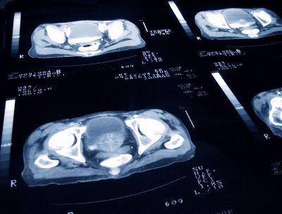 New research reveals the leading cause of cancer globally