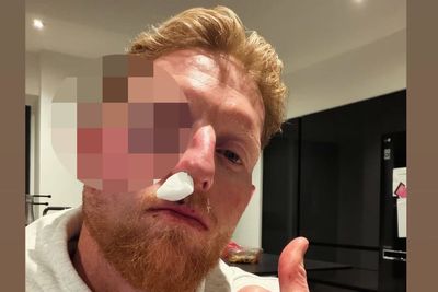 Ben Stokes suffers gruesome facial injury after being struck by a ball