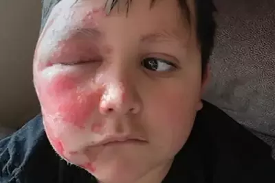 Child suffered second-degree burns partaking in this TikTok challenge, family says