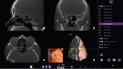 Adding AI to sinus surgery system saw malfunctions rocket from eight to 100 incidents, according to new investigation — skull-puncturing errors are the stuff of nightmares