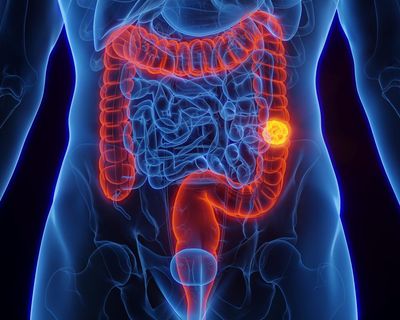 What is colorectal cancer and is it preventable?
