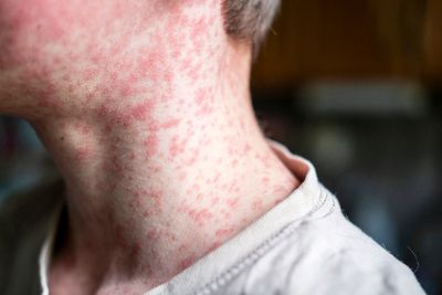 The measles symptoms to look out for as cases rise across UK