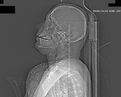 ‘Deliberate targeting of vital body parts’: X-rays taken after Iran protests expose extent of catastrophic injuries