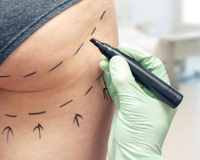 Brazilian butt lifts should be banned in UK amid ‘wild west’ industry, MPs say