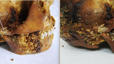 2,500-year-old 'primitive prosthetic' found on jaw of mummified Scythian woman who survived complex jaw surgery