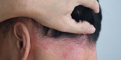 Can losing weight improve psoriasis? What the evidence shows