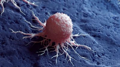 Grail Stock Is Deeply Oversold on Cancer Test Failings. Is There Any Hope Left to Buy the Dip?