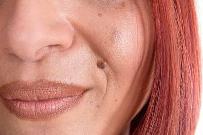 Skin Tags Warning Sign? Hidden Disorder Revealed