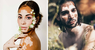 35 Breathtaking Photos Of People With Vitiligo That Redefine What Beauty Looks Like