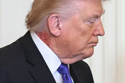 Trump spotted with neck rash during Presidential Medal of Freedom ceremony
