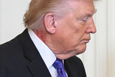 Trump neck rash from ‘preventative’ skin treatment, White House says