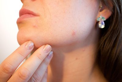 Dermatologist‑Grade Acne Treatments: Retinoids, Benzoyl Peroxide, and Antibiotics Explained
