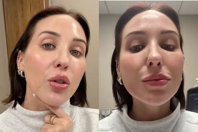 Influencer Jaclyn Hill shares how filler has ‘migrated’ across her face after weight loss